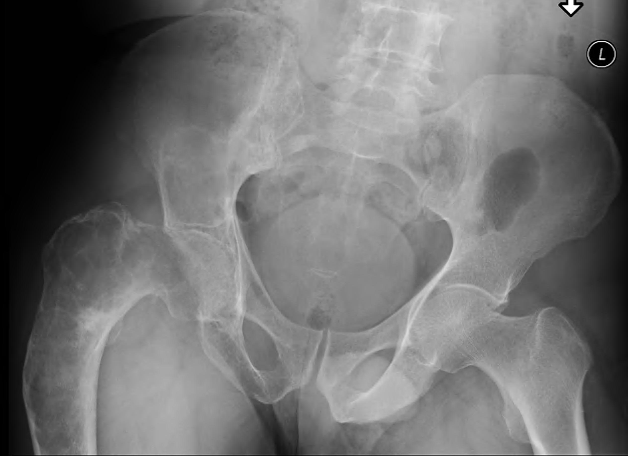 Fibrous Dysplasia Pelvis